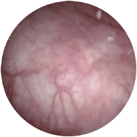 high_grade_papillary_01_8358e1b8f6