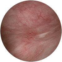 residual_tumour_1_69bf4300fc