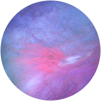 residual_tumour_2_ae043dc7a1